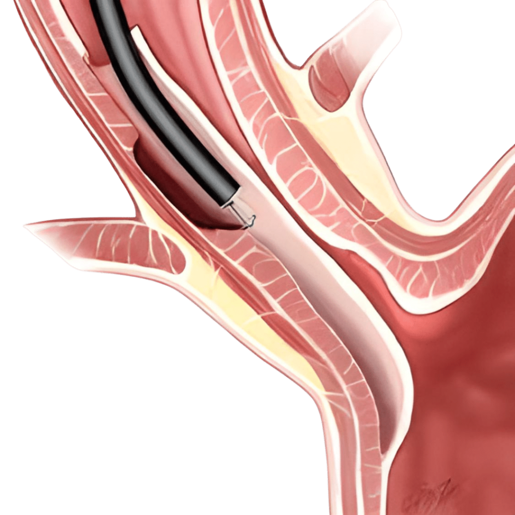 Peroral endoscopic myotomy (POEM)