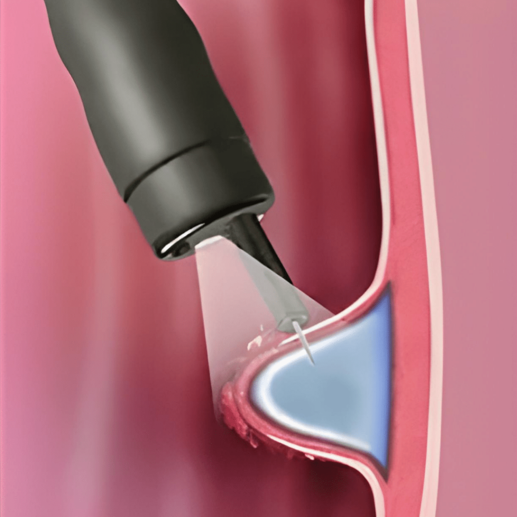 Endoscopic Submucosal Dissection ESD